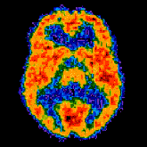 This brain scan is taken from a normal person who is awake. The red color shows the highest level of glucose utilization.