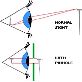 Normal Sight: Normal ray tracing of light to the retina. Shows image will 'flip'.

With Pinhole: Ray tracing of pin through pinhole; a shadow is cast on the retina.