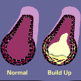 Cholesterol build-up diagram.