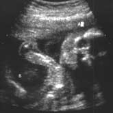 Ultrasound image of human fetus.